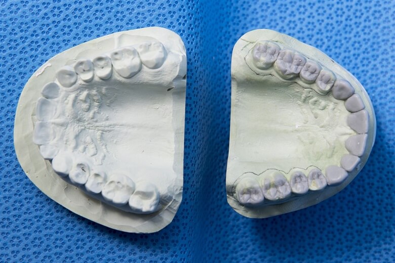 Hulme Court Dental and Implant Centre Dental Services - Dentures Services - Dental Moulds White Figure