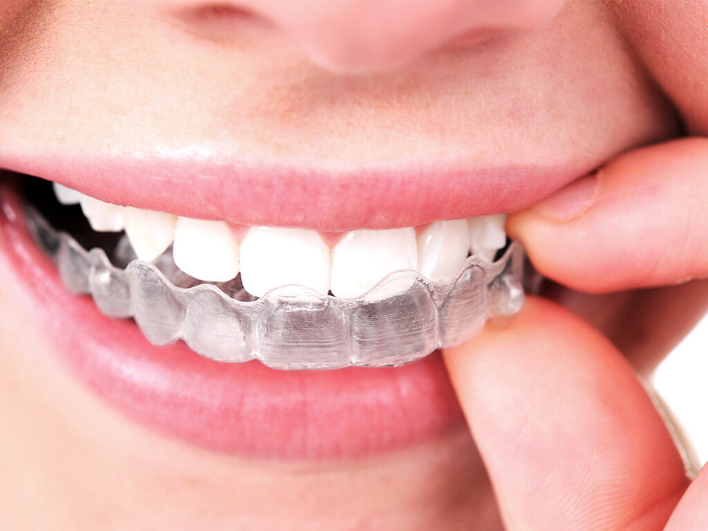 Hulme Court Dental and Implant Centre Dental Services - Invisalign Dentures on the Teeth Picked