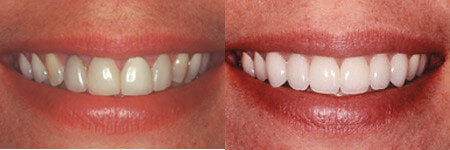 Hulme Court Dental and Implant Centre Dental Services - Smile Make Over Before and After Make Over