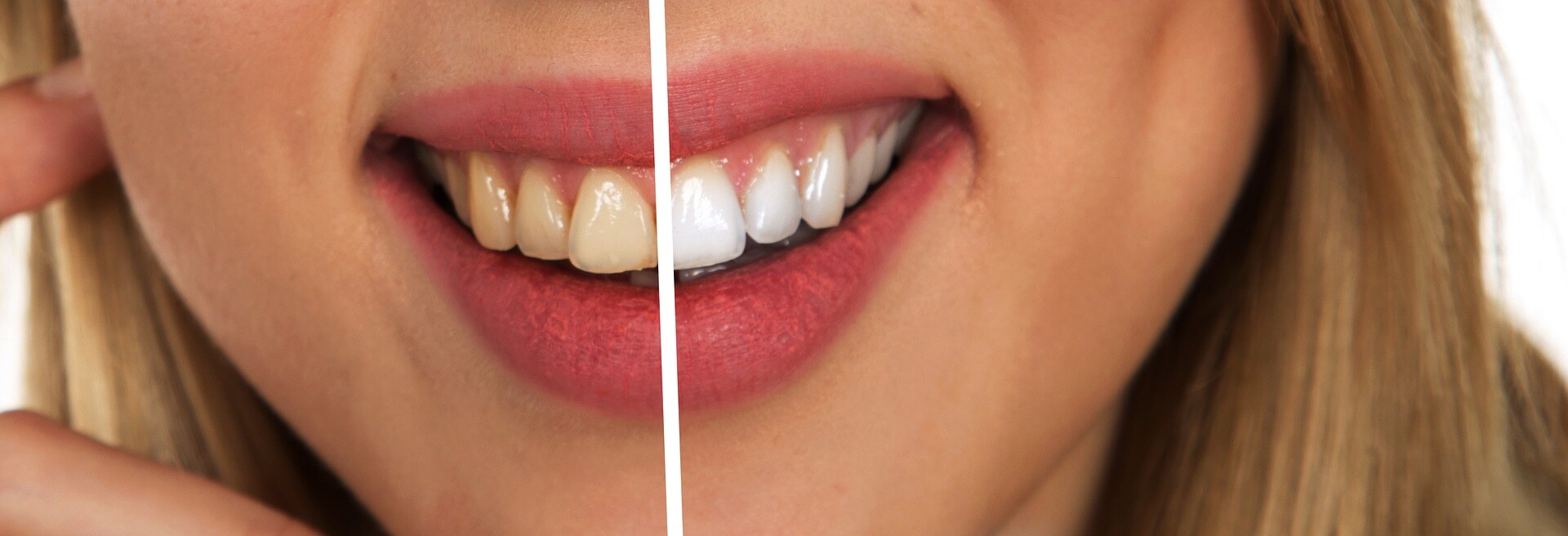 Hulme Court Dental and Implant Centre Dental Services - Teeth Whitening Girls Teeth Compared Before and After